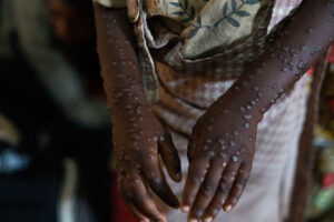 התפתחות מחלת monkeypox מגיעה לזן קטלני: זוהה כעת גם בארה"ב