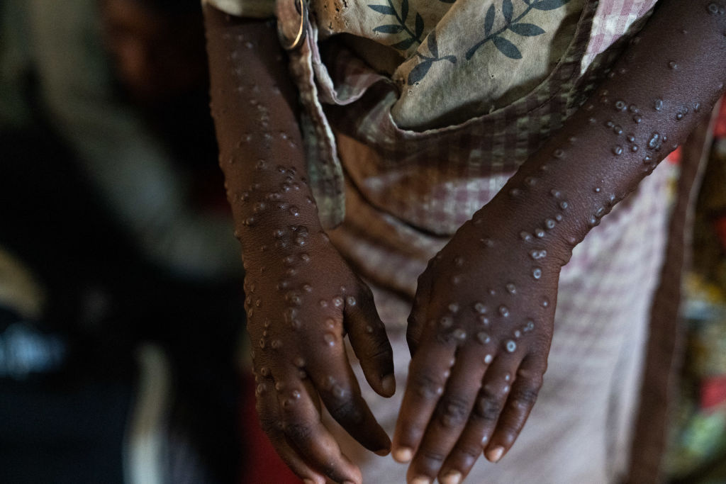 התפתחות מחלת monkeypox מגיעה לזן קטלני: זוהה כעת גם בארה"ב
